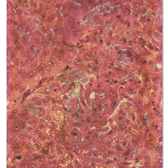 Damien Hirst — M132/727-Lung_cancer-SPL.jpg
